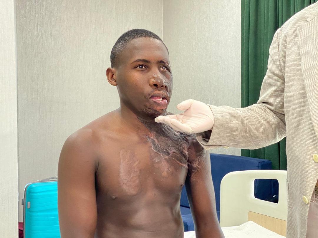 Acılı bekleyiş: Yüzü ve boynunda ağır yanıklar vardı! Ugandalı çoban, 10 yıl sonra Türkiye de tedavi edildi... 3
